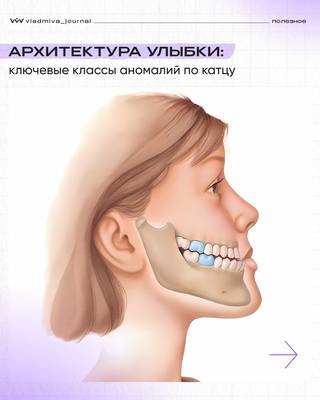 Аномалии прикуса по Катцу: диагностика и лечение.
